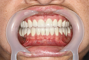 After treatment
