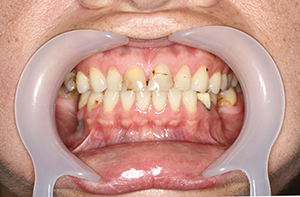 Before treatment