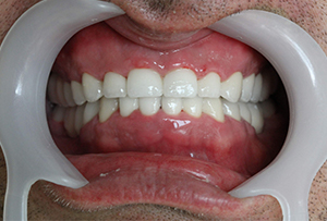 After treatment