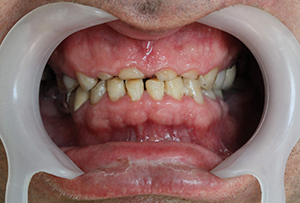 Before treatment