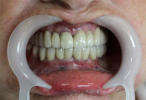 After treatment