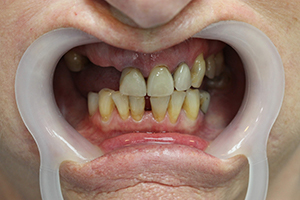 Before treatment