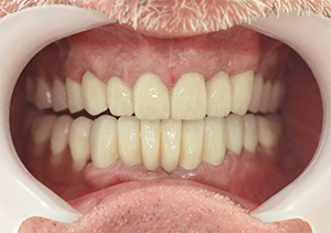 After treatment